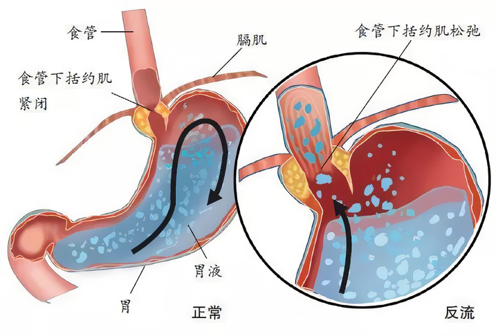 胃食管反流是怎么引起的？探秘胃食管反流病的病因机制与预防策略