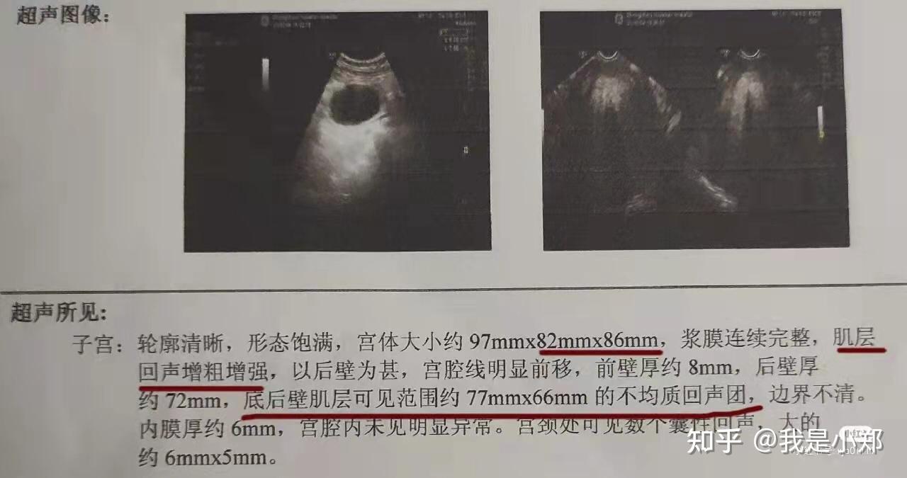 子宫肌层回声不均匀是怎么回事？探究病因、症状及诊疗方法