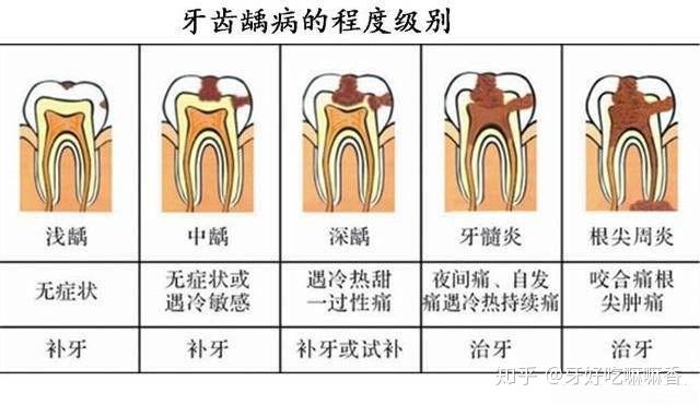 龋齿是怎么回事？深入解析龋齿的成因、预防及治疗