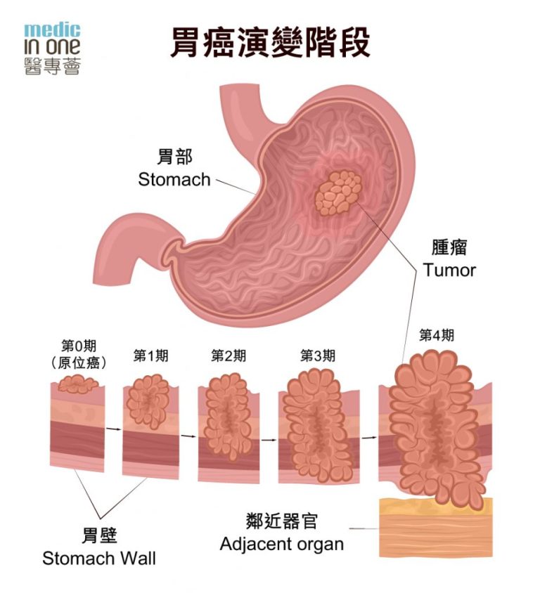 胃癌是怎么引起的？探秘胃癌发病机制及预防策略