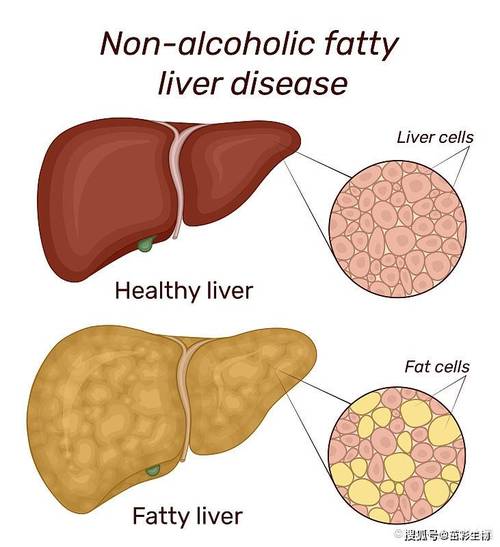 肝脏密度减低是怎么回事？深度解析及常见原因