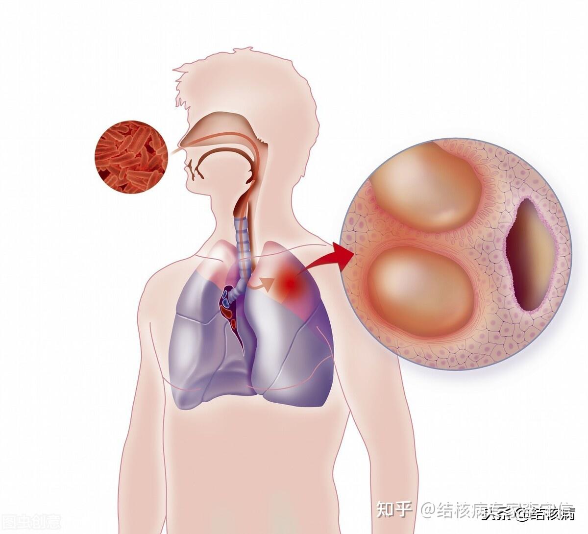 肺结核怎么治疗好得快？详解高效治疗方案及康复策略