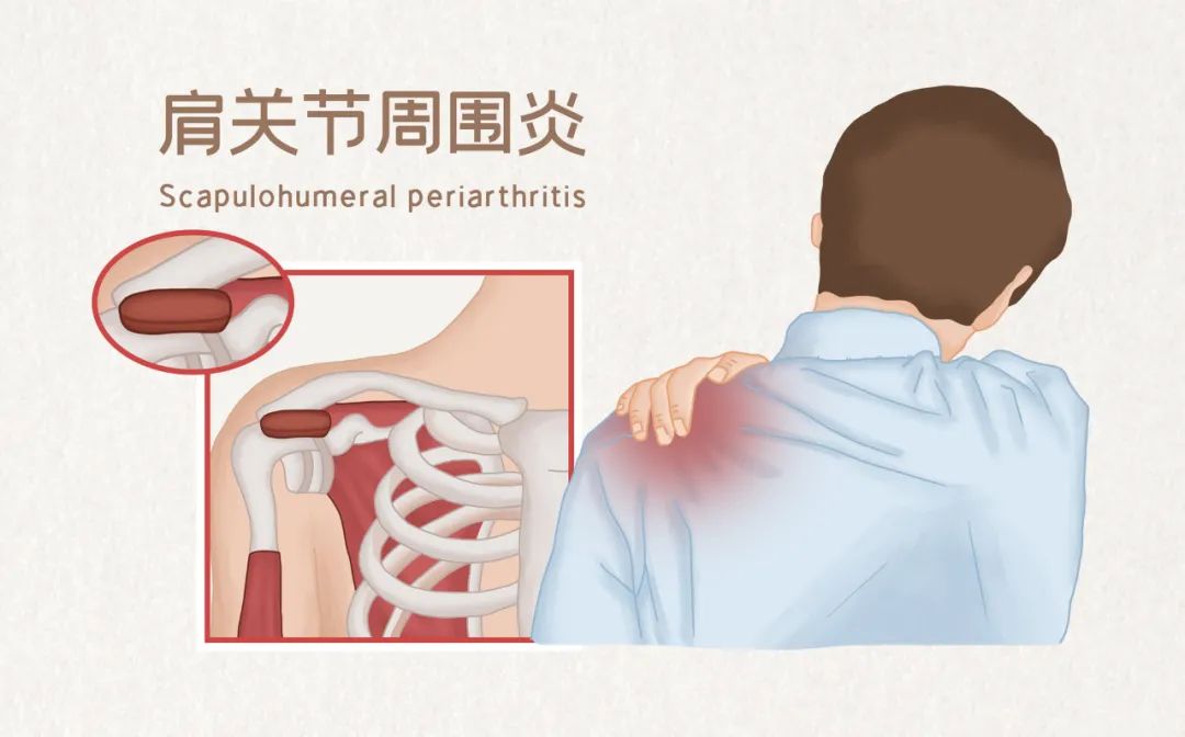 肩周炎怎么办？疼痛难忍？这份实用指南助您摆脱困扰！