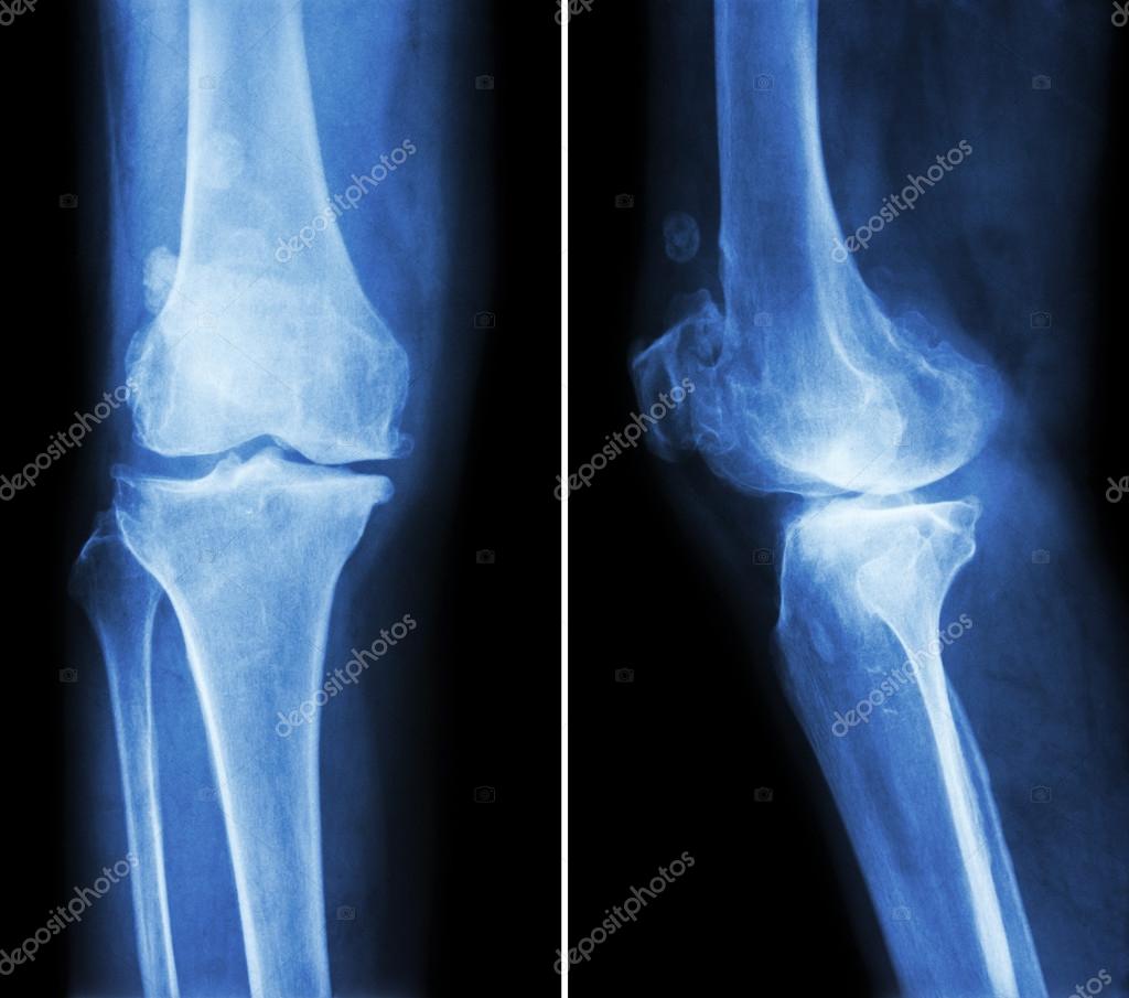 骨刺怎么回事？深入探讨骨刺成因、症状及治疗方法