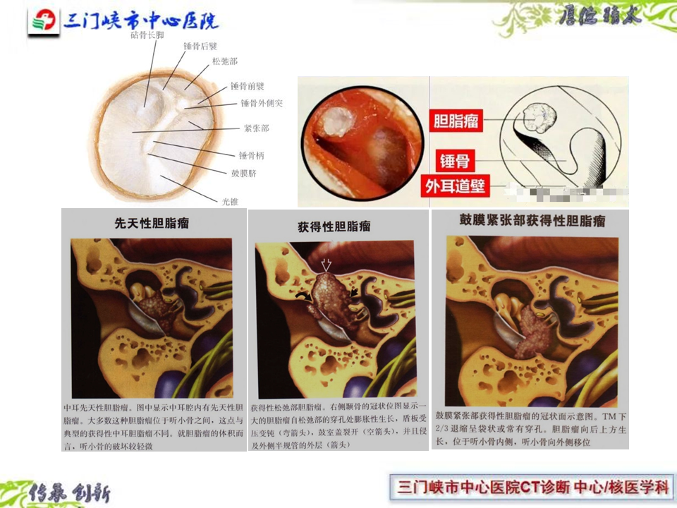 耳朵眼疼是怎么回事？深度解析耳痛的常见原因、症状及应对方法