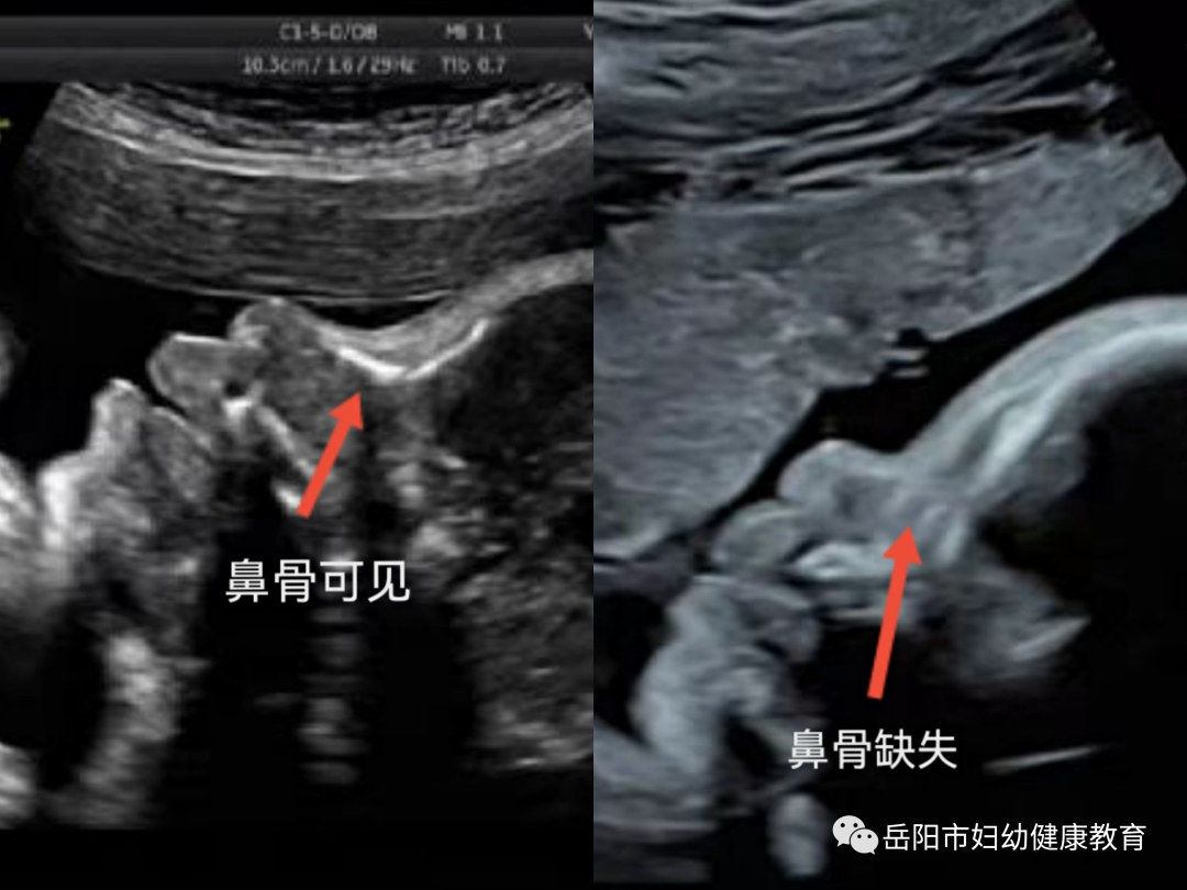 怀孕检查发现地贫怎么办？详解地中海贫血的孕期管理与应对策略