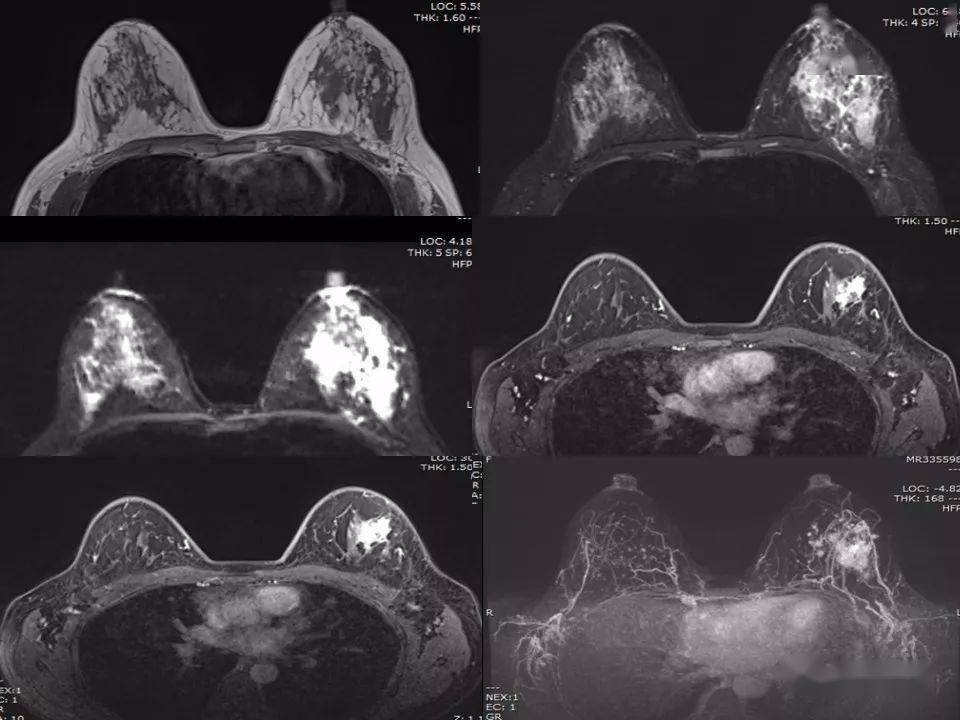 乳腺炎怎么办？有效应对策略及护理指南