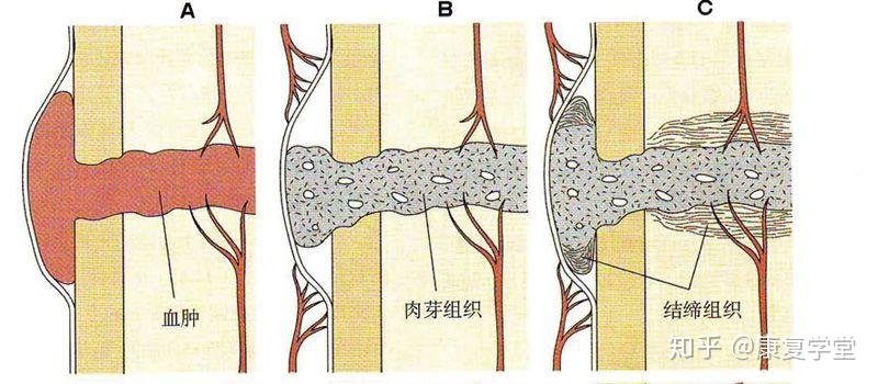 骨折不愈合怎么办？深度解析及应对策略