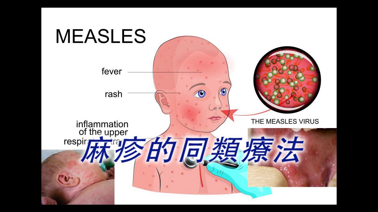 莫麻疹怎样治疗：从原因到治疗方法的全面分析