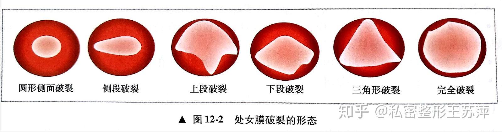 处女膜破了怎么办？理性应对，走出心理困境