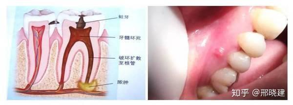 牙根发炎怎么快速消炎？深度解析及有效应对策略