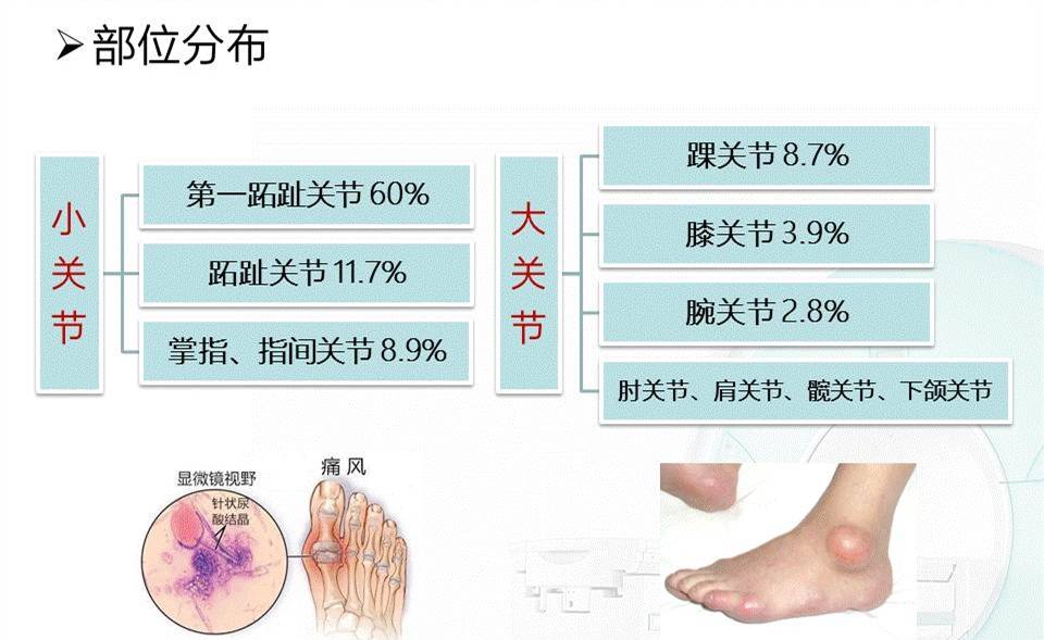 筋痛是怎么回事？深度解析筋骨疼痛的成因、症状及应对方法