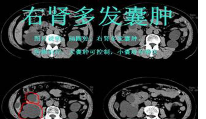 右肾囊肿是怎么回事？详解右肾囊肿的成因、症状、诊断及治疗