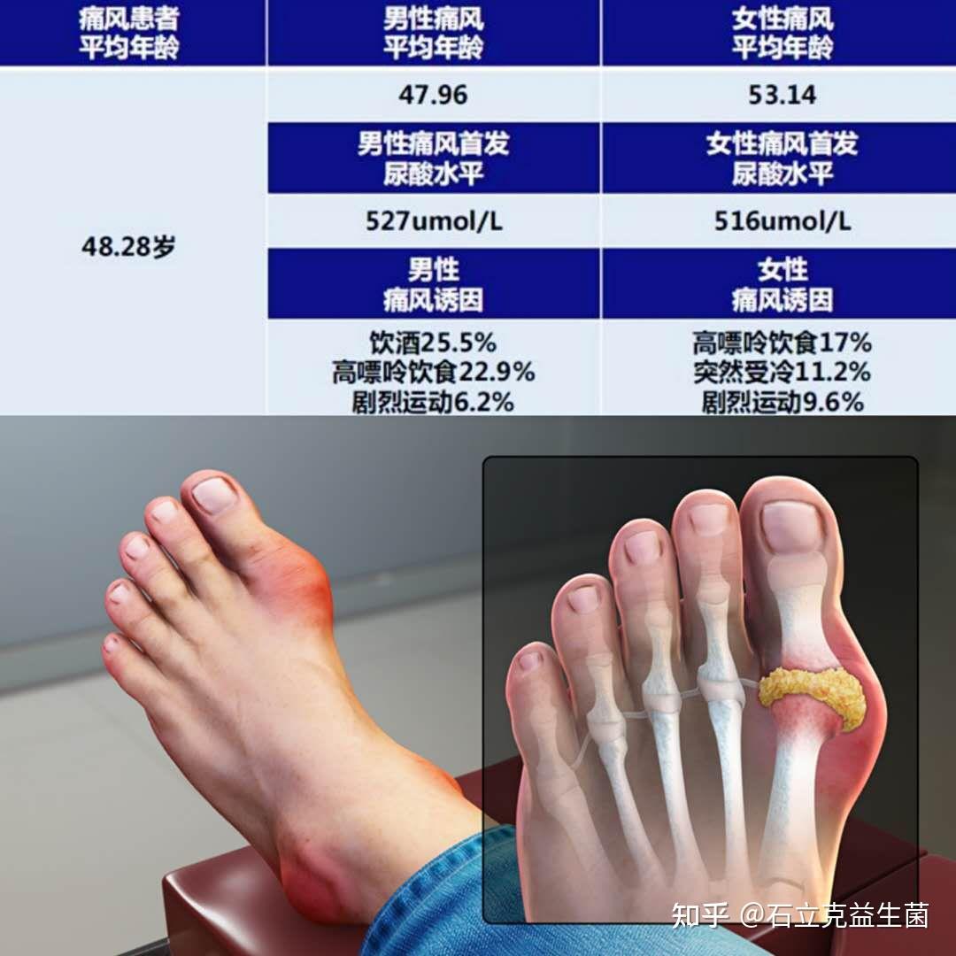 高尿酸血症是怎么回事？深度解析高尿酸的成因、症状及预防