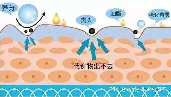 黑头怎么去除？深度解析黑头形成原因及有效去除方法