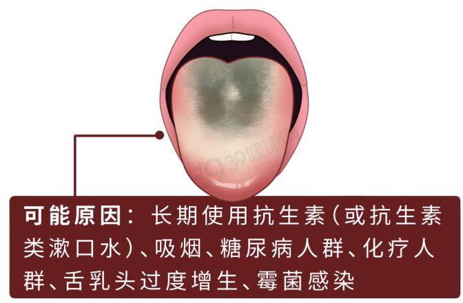 舌头发黑怎么回事？深度解析舌苔颜色变化与健康的关系