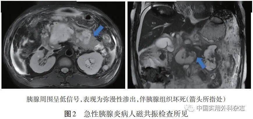 急性胰腺炎怎么引起的？胆结石、酗酒等多重因素深度解析