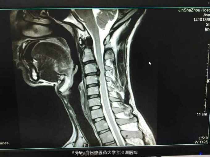 脊髓型颈椎病怎么治疗效果好？权威解读及最新疗法