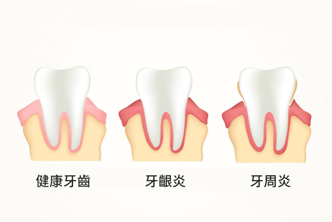 牙周炎怎么治疗与日常保养：专业解析及实用指南