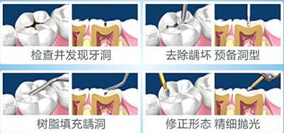 蛀牙痛怎么办？缓解疼痛及预防措施全攻略