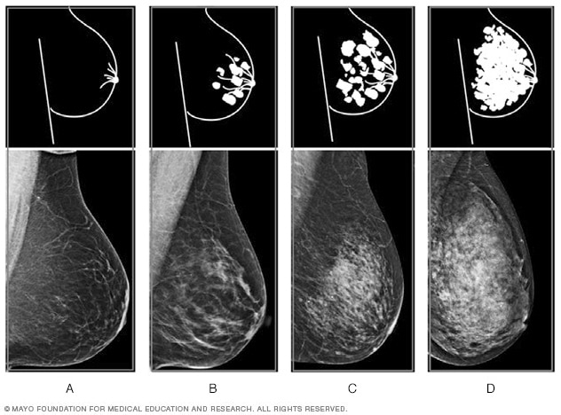 乳管扩张是怎么回事？深度解析乳房疾病的成因、症状及治疗