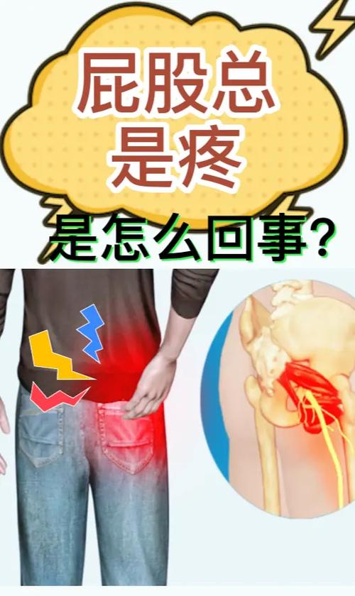 屁股痛怎么缓解？有效方法及潜在风险深度解析