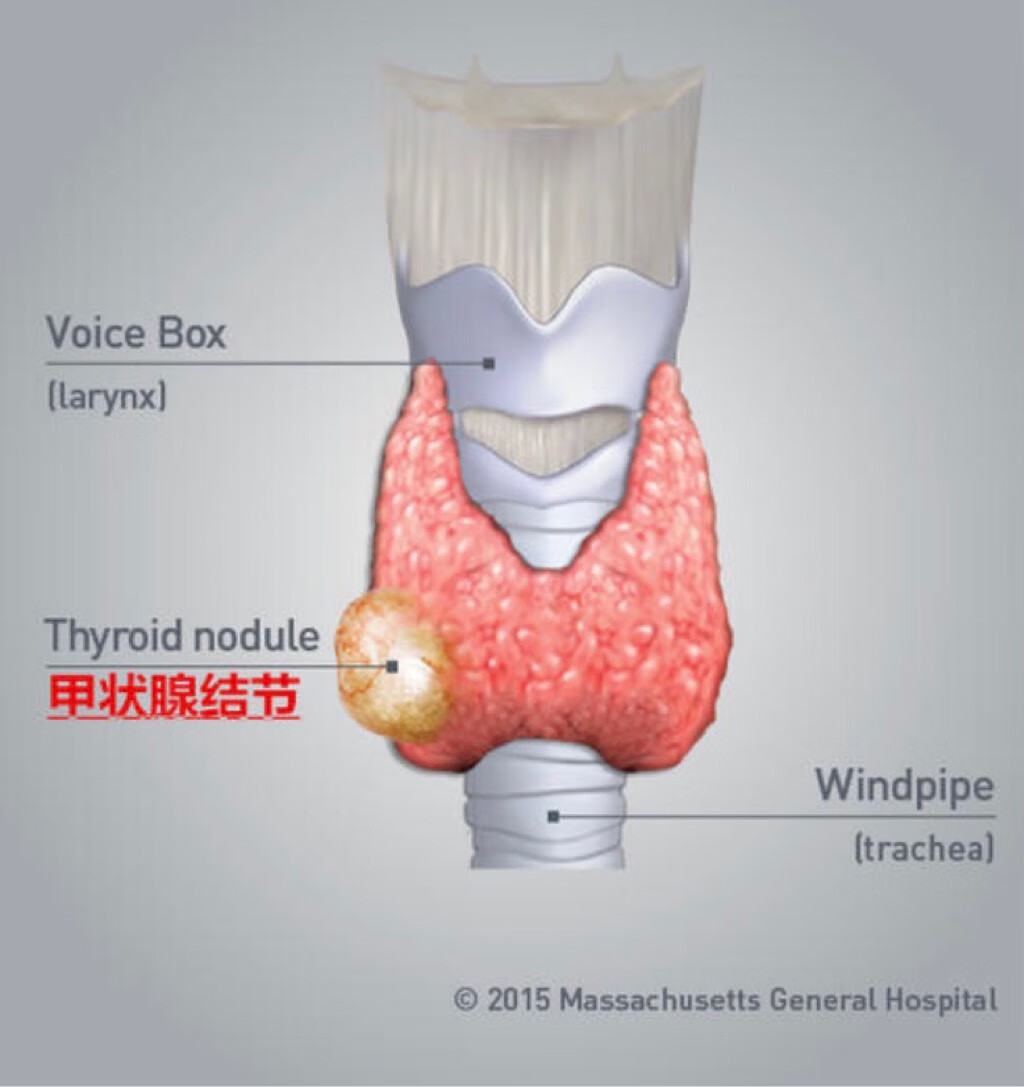 甲状腺结节是怎么回事？全面解读甲状腺结节的成因、症状、诊断与治疗