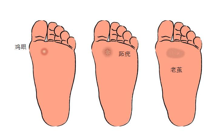 脚起水泡怎么办？完整处理指南及预防措施