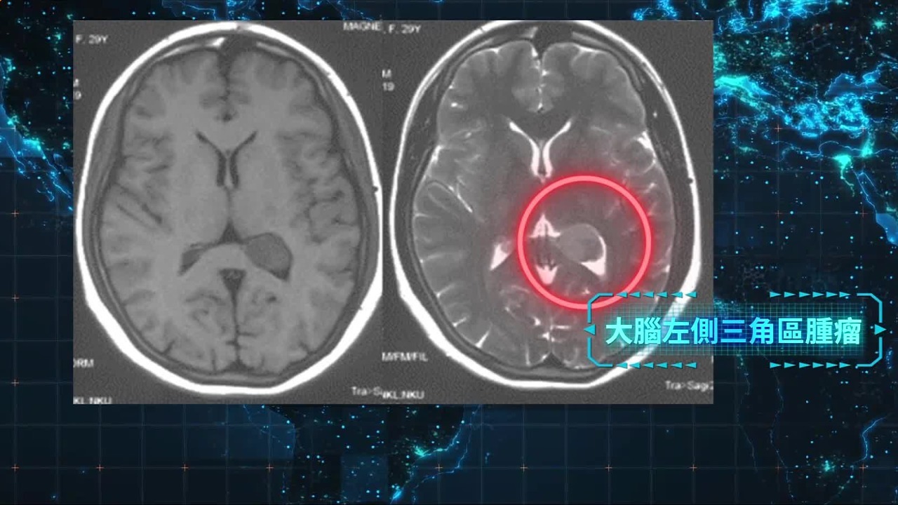 脑白质病变怎么治疗？深度解析治疗方案及未来展望