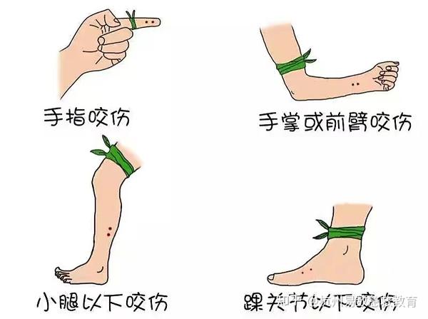 被蛇咬怎么办？野外急救与医院治疗指南