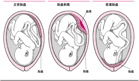 早期孕娠怎么流肢好？安全流肢的选择与注意事项