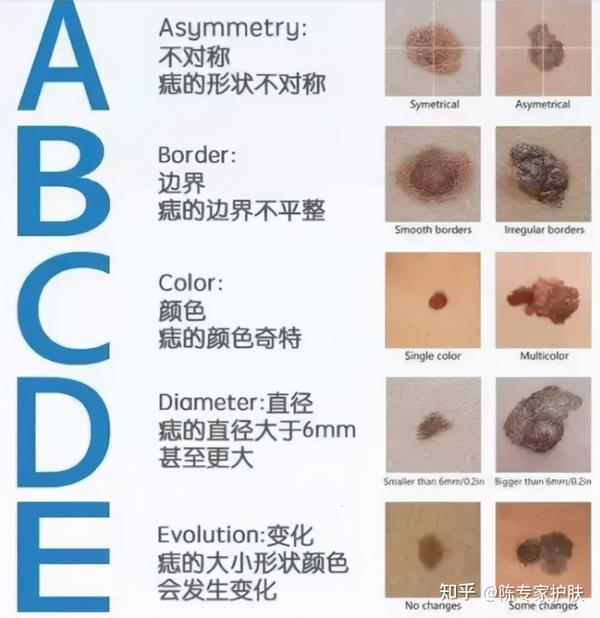 红色的痣是怎么回事？探秘红色痣的成因、类型及潜在风险