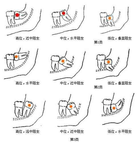 智齿怎么治疗？详解智齿拔除、阻生智齿处理及术后护理