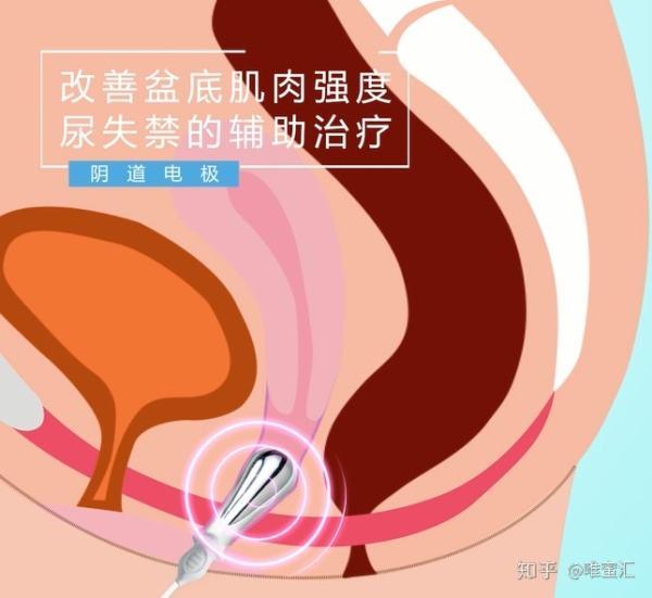 一打喷嚏就漏尿怎么回事？女性盆底功能障碍的常见症状及应对方法