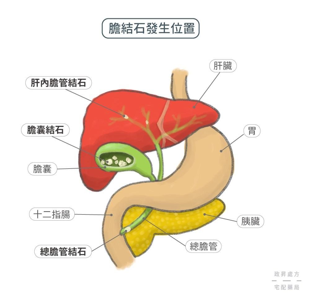 胆结石一般怎么治疗？详解治疗方法、风险及未来趋势