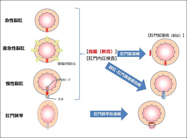 大便肛裂怎么办？疼痛难忍的肛裂，完整诊疗及护理指南