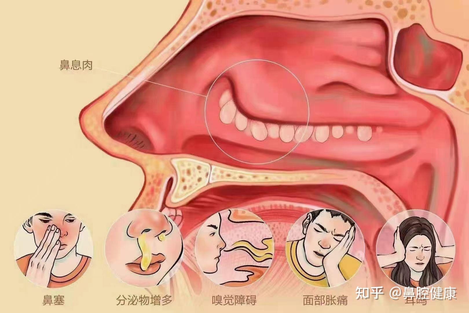 鼻屎是怎么产生的？深入探究鼻腔分泌物形成的奥秘