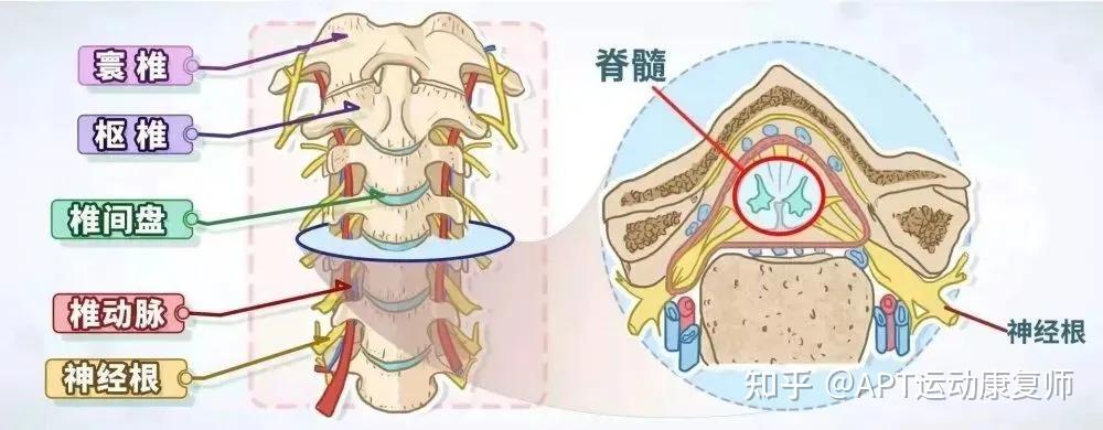 颈椎病压迫神经怎么治疗最好？权威解读及个性化方案