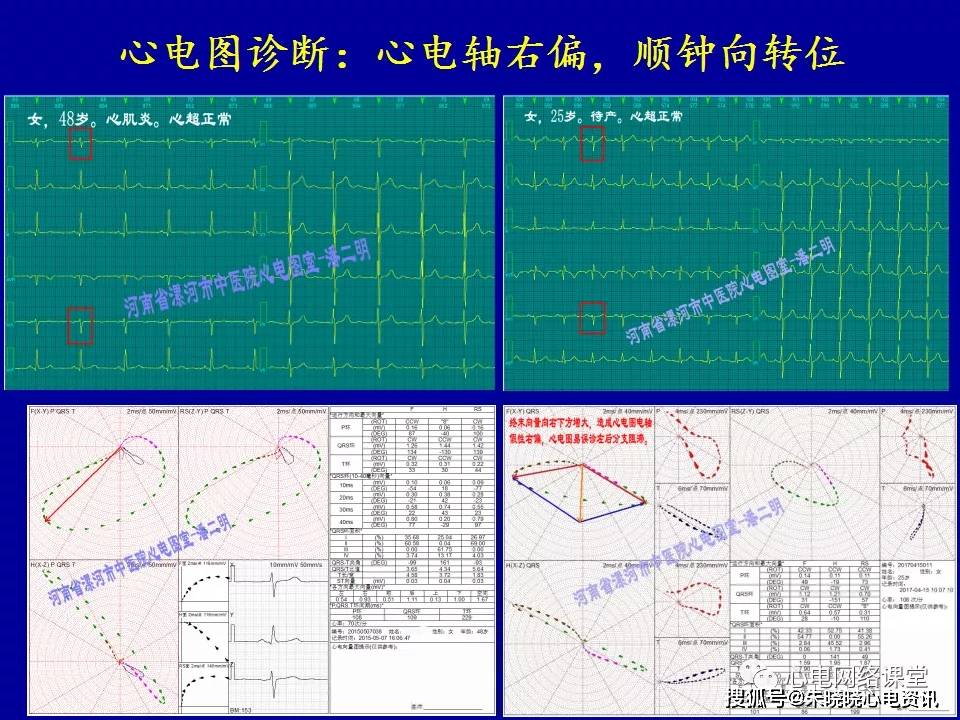 心电轴右偏怎么回事？深度解析心电图解读及临床意义