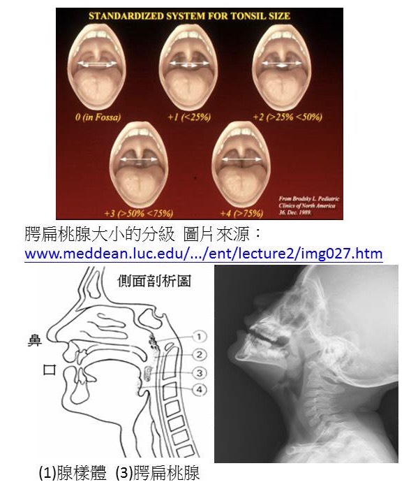 扁桃体肥大怎么调理才能萎缩？有效方法及注意事项深度解析