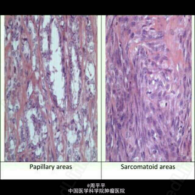 乳头状瘤是怎么引起的？探秘致病因素及预防策略