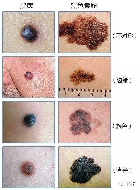 红痣越来越多是怎么回事？皮肤病变的可能性及应对策略