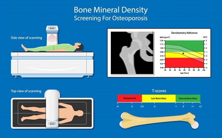 骨密度怎么检查？详解骨密度检查方法、优缺点及最新技术