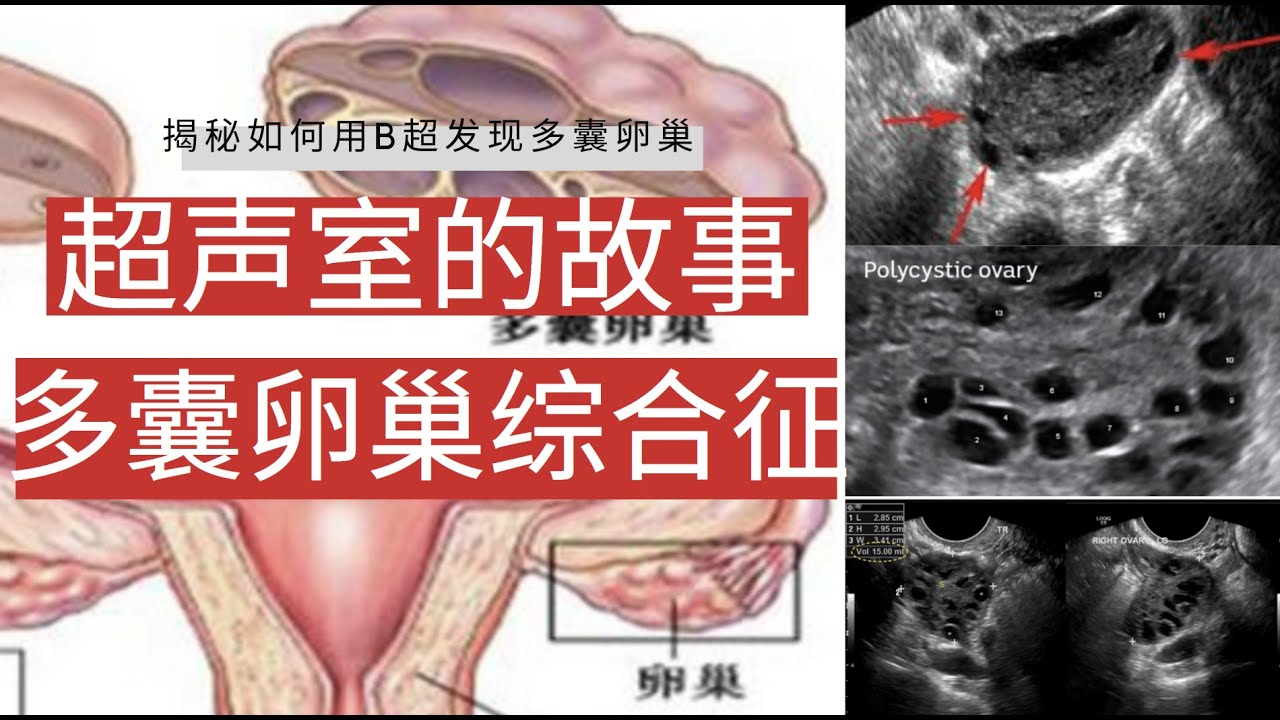 怎么判断自己是不是多囊？多囊卵巢综合征的早期症状和诊断方法