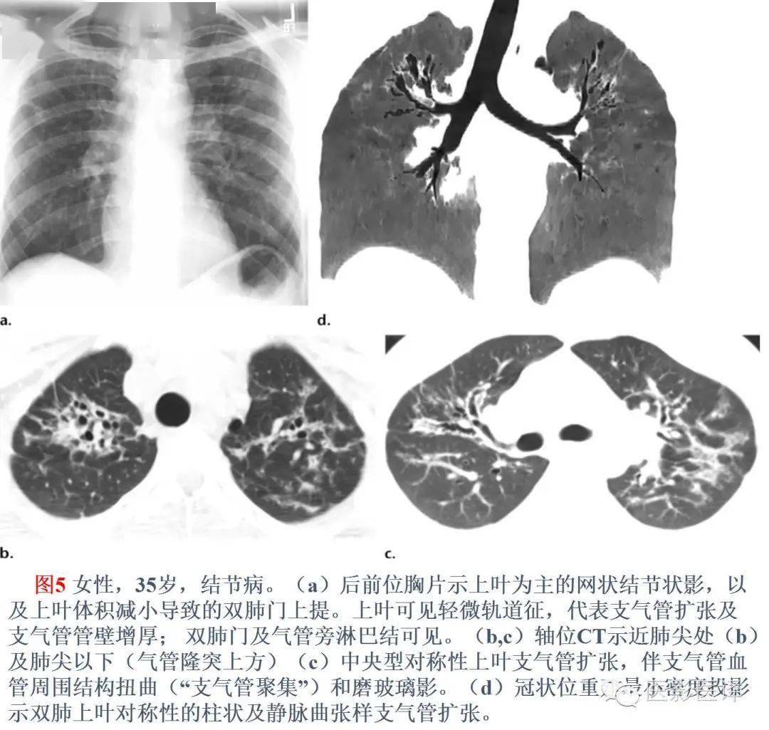 支气管炎是怎么形成的？探秘病因机制及预防策略