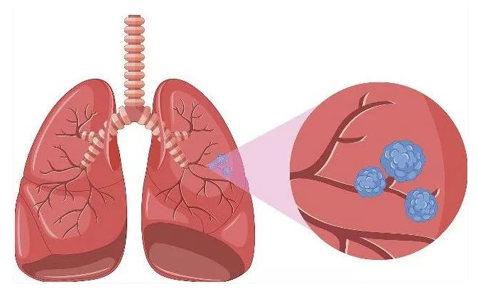 肺结节是怎么引起的？探究肺结节成因及预防策略