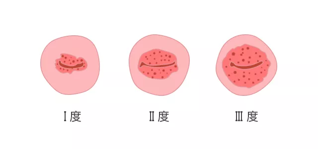 宫颈糜烂二度怎么治疗？权威解读及治疗方案选择