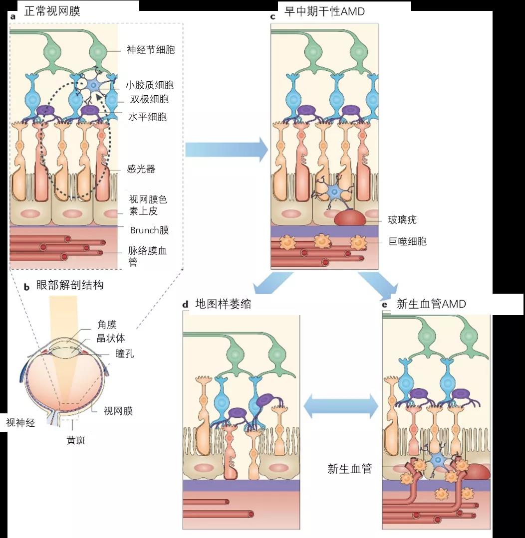 眼睛黄斑病变怎么治疗最好？权威指南及最新疗法解读