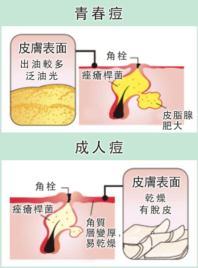 脸上长痘痘怎么办？深度解析痘痘成因及有效应对方法